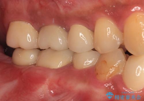 目立つ金属をすべてセラミックに 全顎的メタルフリー治療の治療後