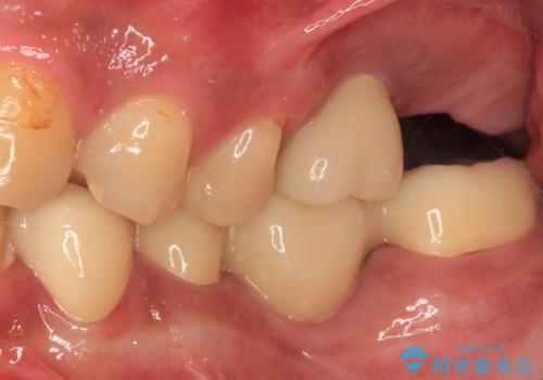 目立つ金属をすべてセラミックに 全顎的メタルフリー治療の治療後