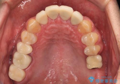目立つ金属をすべてセラミックに 全顎的メタルフリー治療の治療後