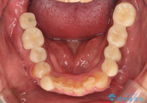 目立つ金属をすべてセラミックに 全顎的メタルフリー治療の治療後