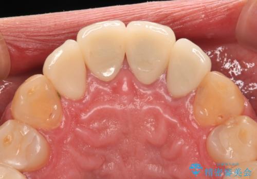 目立つ金属をすべてセラミックに 全顎的メタルフリー治療の治療後