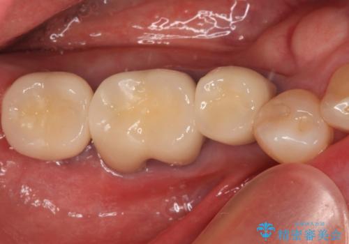 欠損した奥歯のインプラント補綴治療の症例 治療後