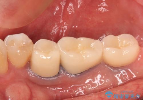 欠損した奥歯のインプラント補綴治療の治療後