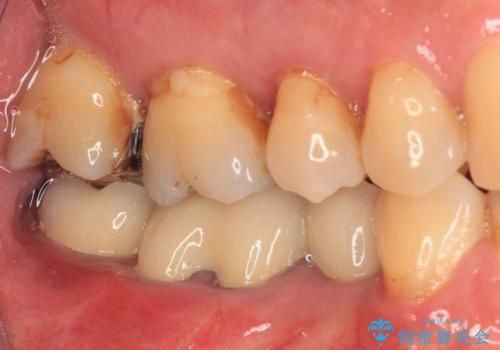 欠損した奥歯のインプラント補綴治療の治療後