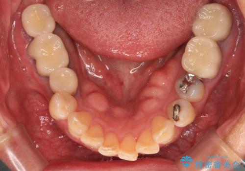欠損した奥歯のインプラント補綴治療の治療後