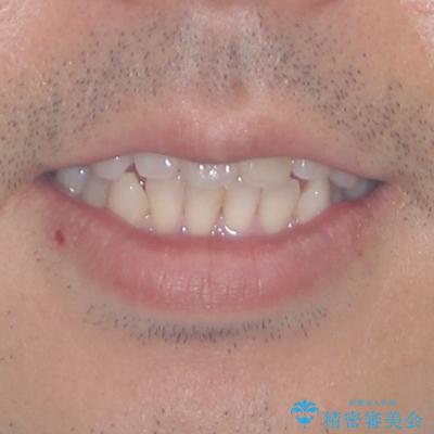 内側に転位した歯とボロボロのむし歯　インビザラインによる矯正治療とむし歯治療の治療前（顔貌）