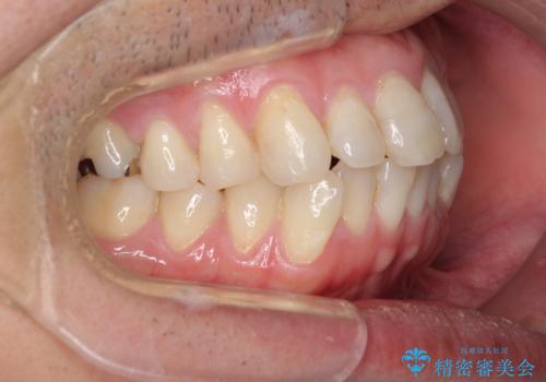 内側に転位した歯とボロボロのむし歯　インビザラインによる矯正治療とむし歯治療の治療前
