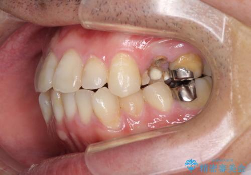内側に転位した歯とボロボロのむし歯　インビザラインによる矯正治療とむし歯治療の治療前