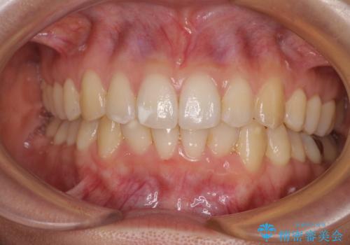 【モニター】前歯のデコボコとクロスバイト インビザラインによる矯正治療の治療中