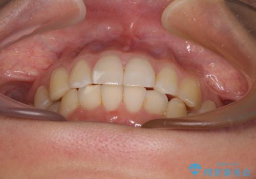 【モニター】前歯のデコボコとクロスバイト インビザラインによる矯正治療の治療中