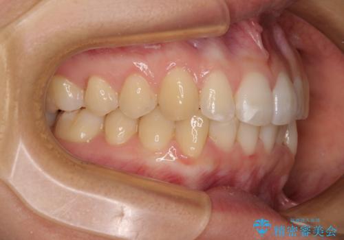 【モニター】前歯のデコボコとクロスバイト インビザラインによる矯正治療の治療中