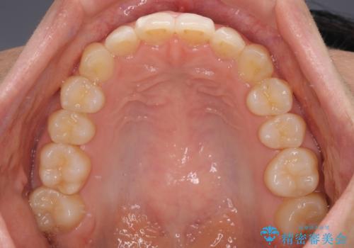 【モニター】前歯のデコボコとクロスバイト　インビザラインによる矯正治療の治療中