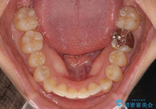 【モニター】前歯のデコボコとクロスバイト インビザラインによる矯正治療の治療中