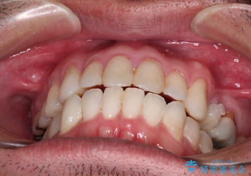 内側に転位した歯とボロボロのむし歯　インビザラインによる矯正治療とむし歯治療の治療中