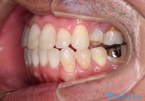 内側に転位した歯とボロボロのむし歯　インビザラインによる矯正治療とむし歯治療の治療中