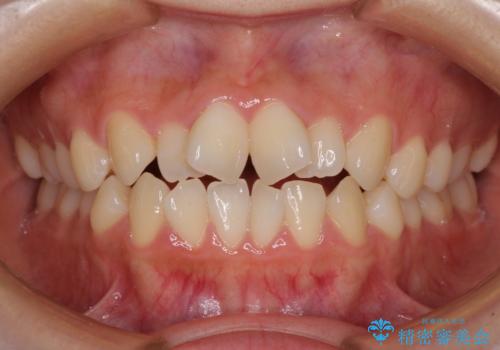 隙間が空いてデコボコした前歯を治したい ワイヤー装置による矯正治療の症例 治療前