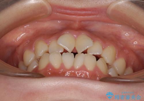 隙間が空いてデコボコした前歯を治したい ワイヤー装置による矯正治療の治療前