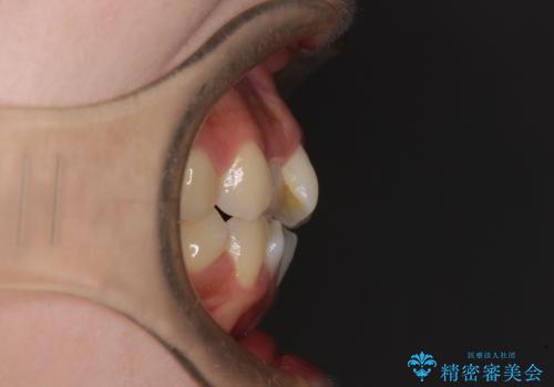 隙間が空いてデコボコした前歯を治したい ワイヤー装置による矯正治療の治療前