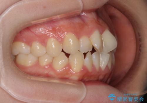 隙間が空いてデコボコした前歯を治したい ワイヤー装置による矯正治療の治療前