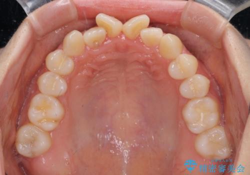 隙間が空いてデコボコした前歯を治したい ワイヤー装置による矯正治療の治療前