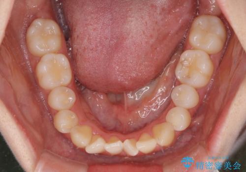 隙間が空いてデコボコした前歯を治したい ワイヤー装置による矯正治療の治療前