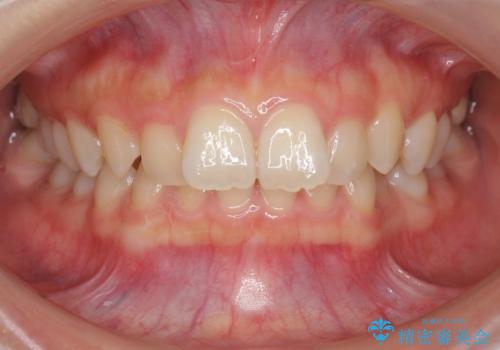 [ 鋏状咬合・過蓋咬合・上顎前突 ]  前歯のガタつき、噛みあわせのズレを矯正治療で改善の症例 治療前