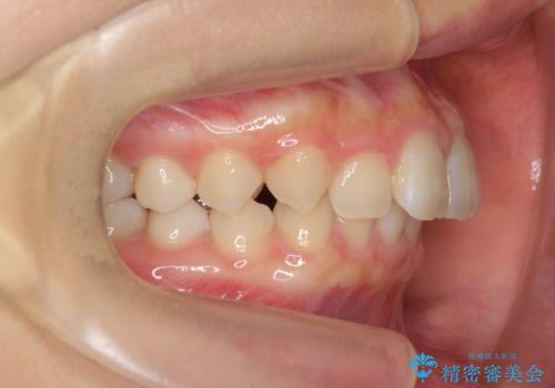 [ 鋏状咬合・過蓋咬合・上顎前突 ]  前歯のガタつき、噛みあわせのズレを矯正治療で改善の治療前