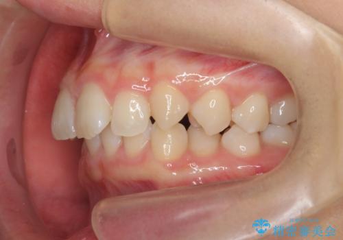 [ 鋏状咬合・過蓋咬合・上顎前突 ]  前歯のガタつき、噛みあわせのズレを矯正治療で改善の治療前