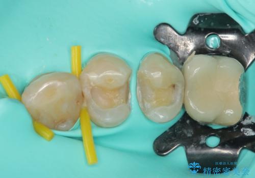 目立つ金属をすべてセラミックに 全顎的メタルフリー治療の治療中