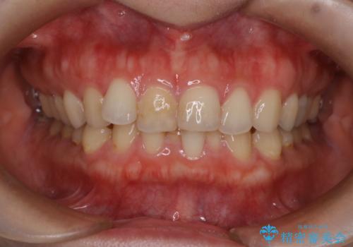 【下顎前歯の抜歯矯正】マウスピース矯正の症例 治療前