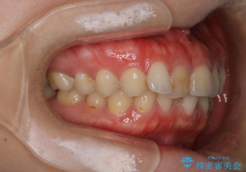 【下顎前歯の抜歯矯正】マウスピース矯正の治療前