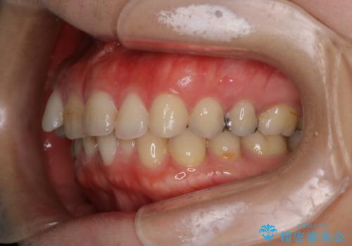 【下顎前歯の抜歯矯正】マウスピース矯正の治療前