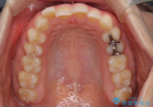 【下顎前歯の抜歯矯正】マウスピース矯正の治療前