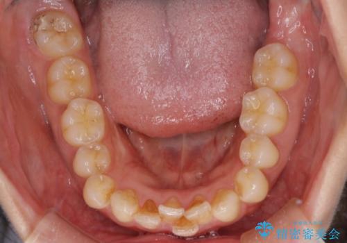 【下顎前歯の抜歯矯正】マウスピース矯正の治療前