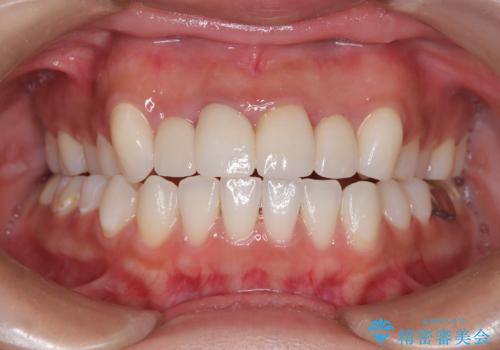 前歯をきれいにしたい、セラミック矯正の治療後