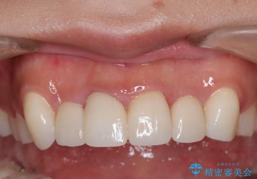 前歯をきれいにしたい、セラミック矯正の治療後