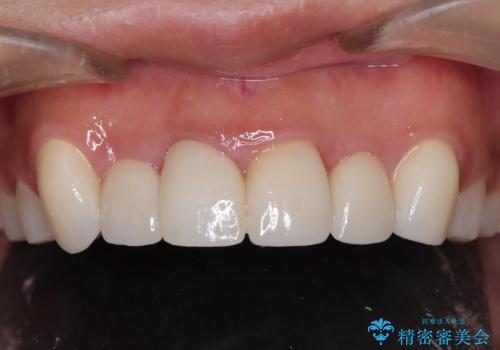 前歯をきれいにしたい、セラミック矯正