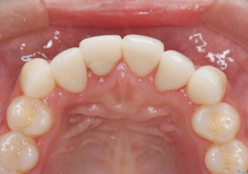 前歯をきれいにしたい、セラミック矯正の治療後