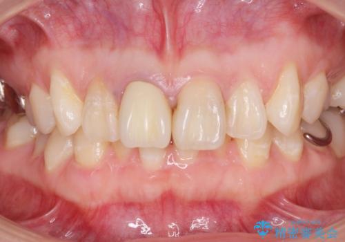 前歯の色が気になる。の治療前