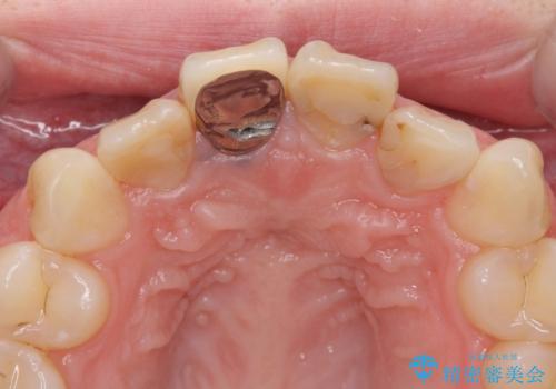 前歯の色が気になる。の治療前