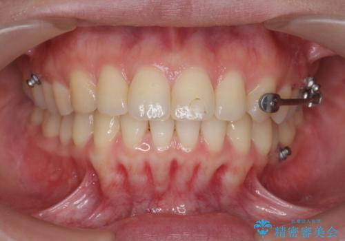 カリエール・マイクロインプラントを併用した歯の突出を改善する大きな遠心移動の治療前