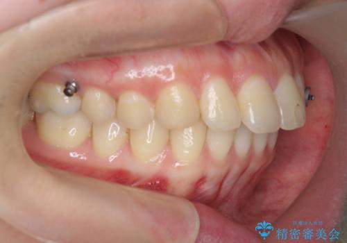 カリエール・マイクロインプラントを併用した歯の突出を改善する大きな遠心移動の治療前