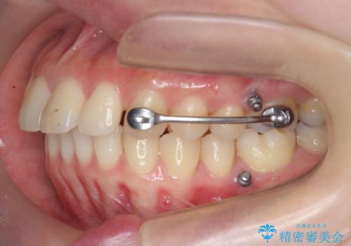 カリエール・マイクロインプラントを併用した歯の突出を改善する大きな遠心移動の治療前