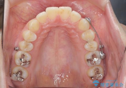 カリエール・マイクロインプラントを併用した歯の突出を改善する大きな遠心移動の治療前