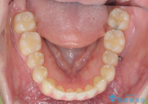 カリエール・マイクロインプラントを併用した歯の突出を改善する大きな遠心移動の治療前