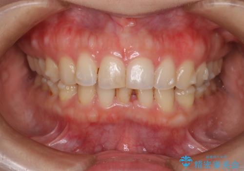 【下顎前歯の抜歯矯正】マウスピース矯正の治療中