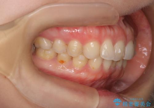 【下顎前歯の抜歯矯正】マウスピース矯正の治療中