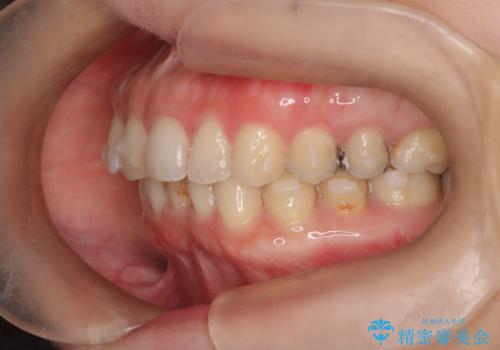 【下顎前歯の抜歯矯正】マウスピース矯正の治療中