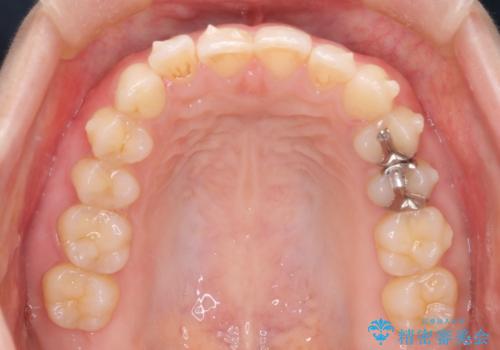 【下顎前歯の抜歯矯正】マウスピース矯正の治療中