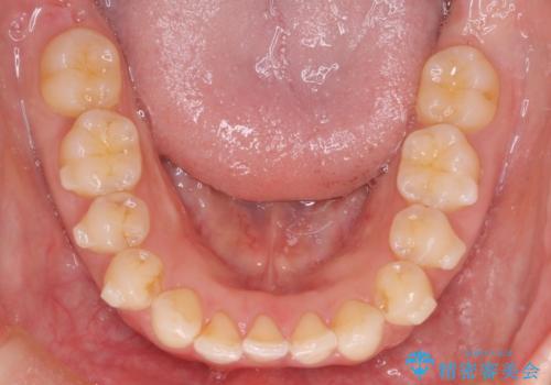 【下顎前歯の抜歯矯正】マウスピース矯正の治療中